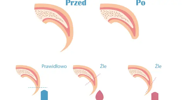 Ilustracja pokazuje, jak obciąć pazury psu który się wyrywa. Prawidłowe cięcie jest pokazane z niebieskim obcinaczem, a złe cięcie z krwawiącą kroplą lub obcinaczem zbyt blisko nerwu.